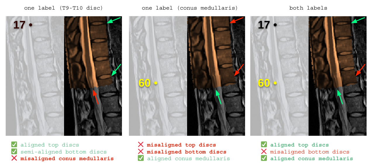 https://raw.githubusercontent.com/spinalcordtoolbox/doc-figures/master/lumbar-registration/label-comparison.png