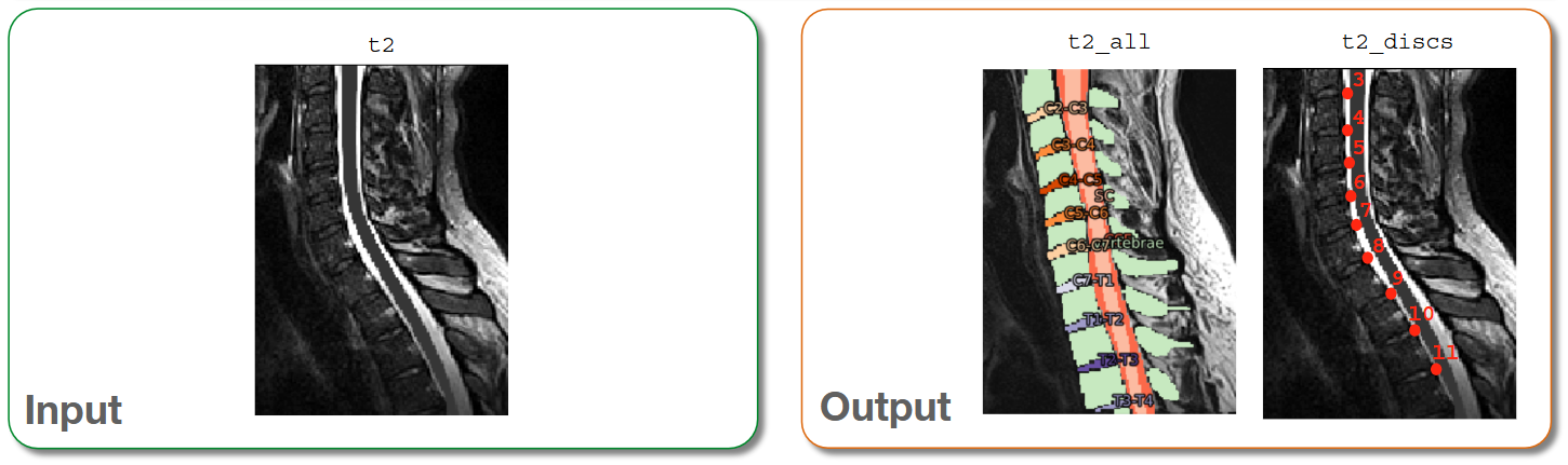 https://raw.githubusercontent.com/spinalcordtoolbox/doc-figures/master/vertebral-labeling/io-sct_deepseg_spine.png