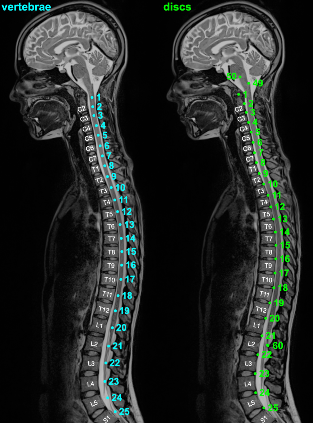 https://raw.githubusercontent.com/spinalcordtoolbox/doc-figures/master/vertebral-labeling/vertebral-labeling-conventions.png