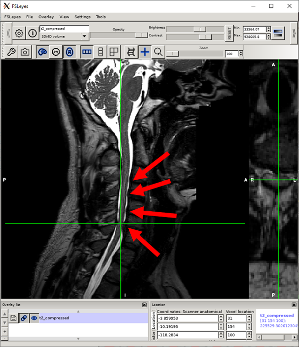 https://raw.githubusercontent.com/spinalcordtoolbox/doc-figures/sb/4158-add-tutorial-sct-compute-compression/spinalcord-compresssion-norm/localizing_compression_sag.png