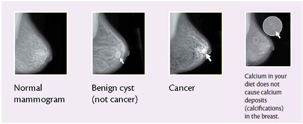 Difference between Malignant and Benign tissues in Breast