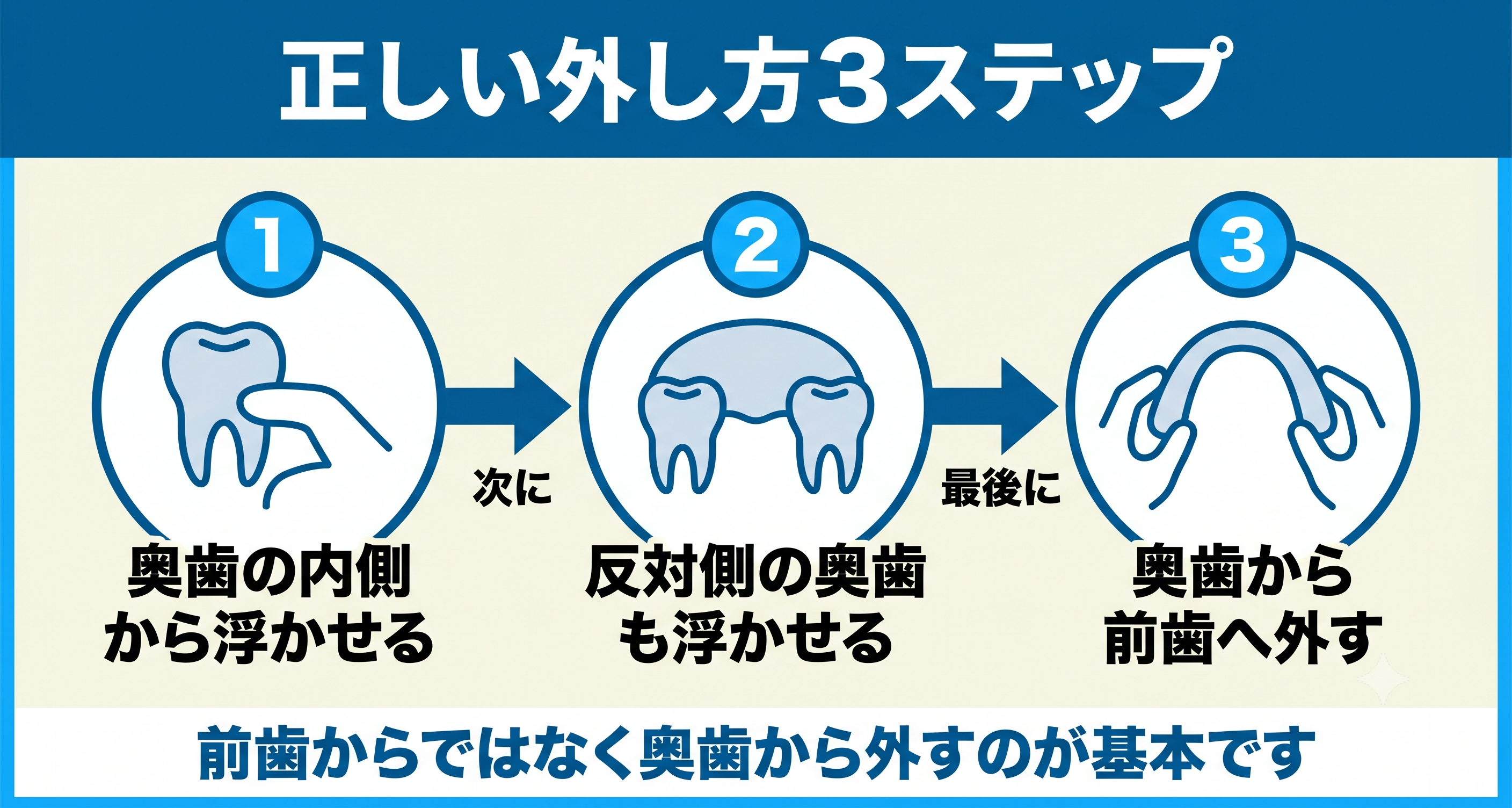 インビザラインのマウスピースが外せない時の正しい外し方を3ステップで示した図解。奥歯の内側から浮かせ、反対側の奥歯も浮かせてから、奥歯から前歯へと外す流れを表し、前歯からではなく奥歯から外すのが基本であることを示す。