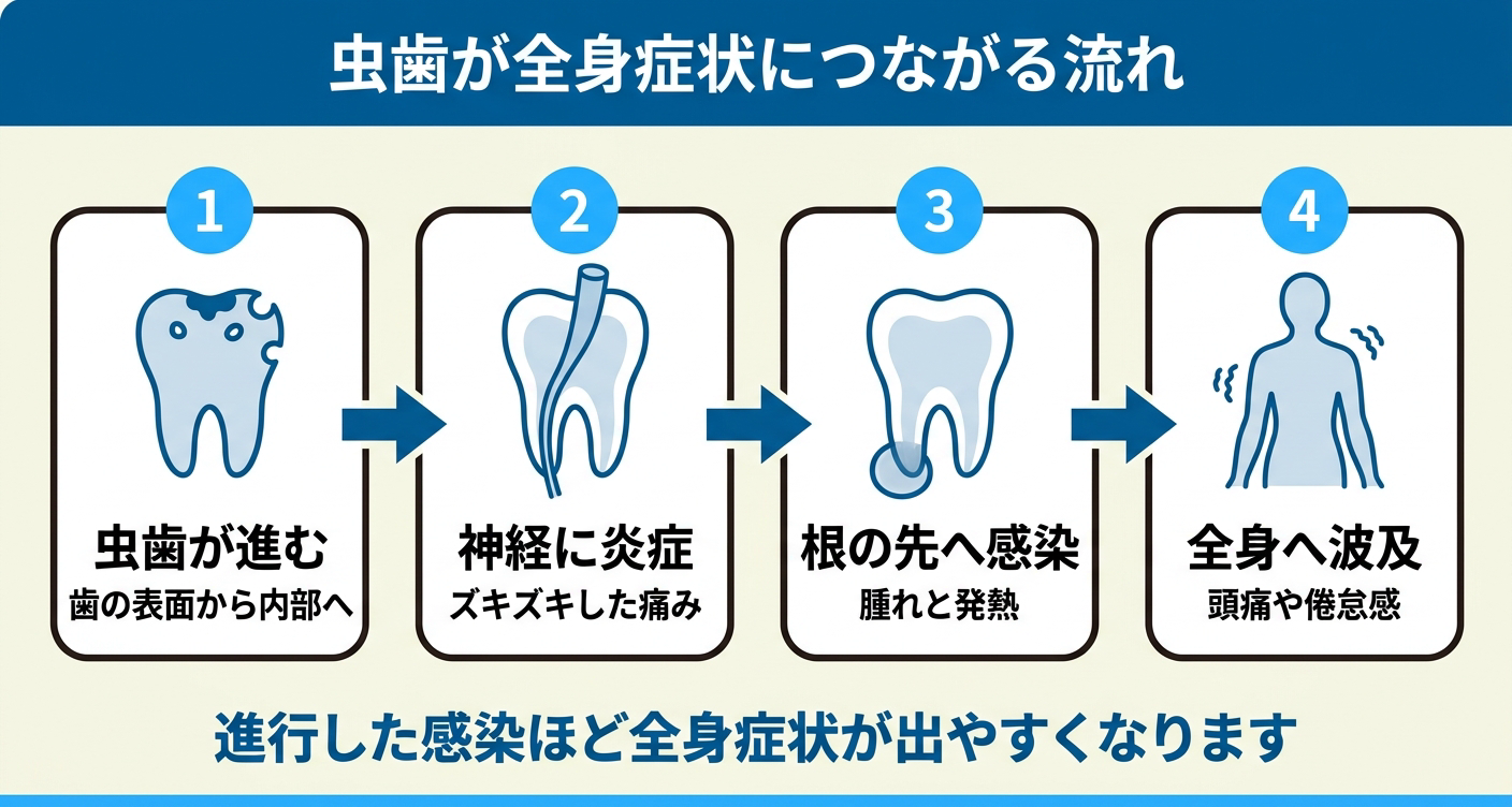 虫歯が頭痛や発熱など全身症状につながる流れを4ステップで整理した図解。歯の内部へ虫歯が進み、神経の炎症で痛みが出て、根の先の感染で腫れと発熱が起き、全身へ波及する経路を示し、進行した感染ほど全身症状が出やすいと伝える。