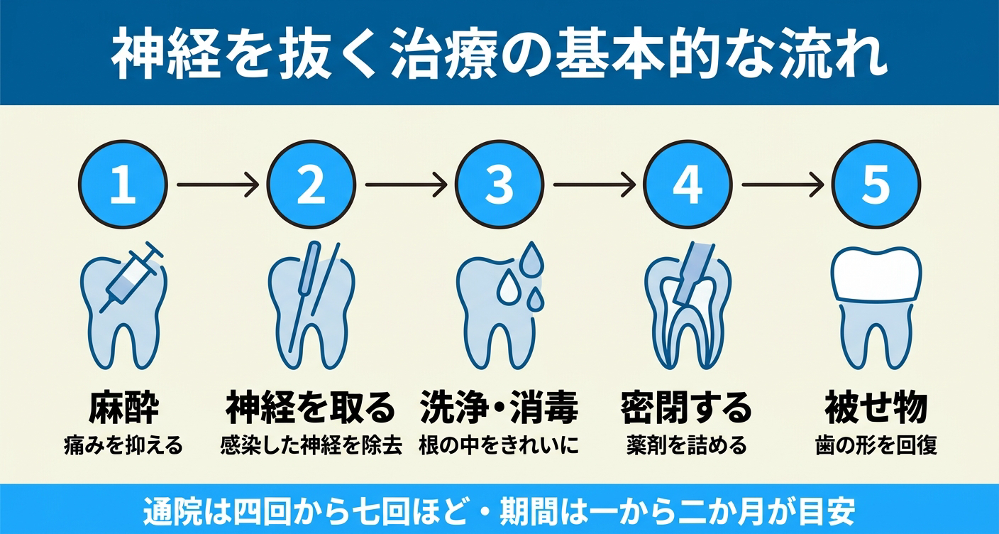 虫歯の根管治療で神経を抜く治療の基本的な流れを五段階で示した図解。麻酔から神経の除去、根の中の洗浄・消毒、薬剤での密閉、被せ物による形の回復までを順に並べ、通院は四回から七回ほど、期間は一から二か月が目安であることを伝える。