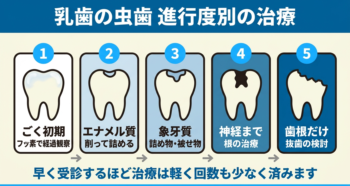 乳歯の虫歯の進行度別の治療方法を5段階で整理した図解。ごく初期はフッ化物で経過観察、エナメル質は削って詰める、象牙質は詰め物、神経まで進むと根の治療、歯根だけ残ると抜歯が検討され、早く受診するほど治療負担を抑えやすいことを伝える歯科情報イラスト。