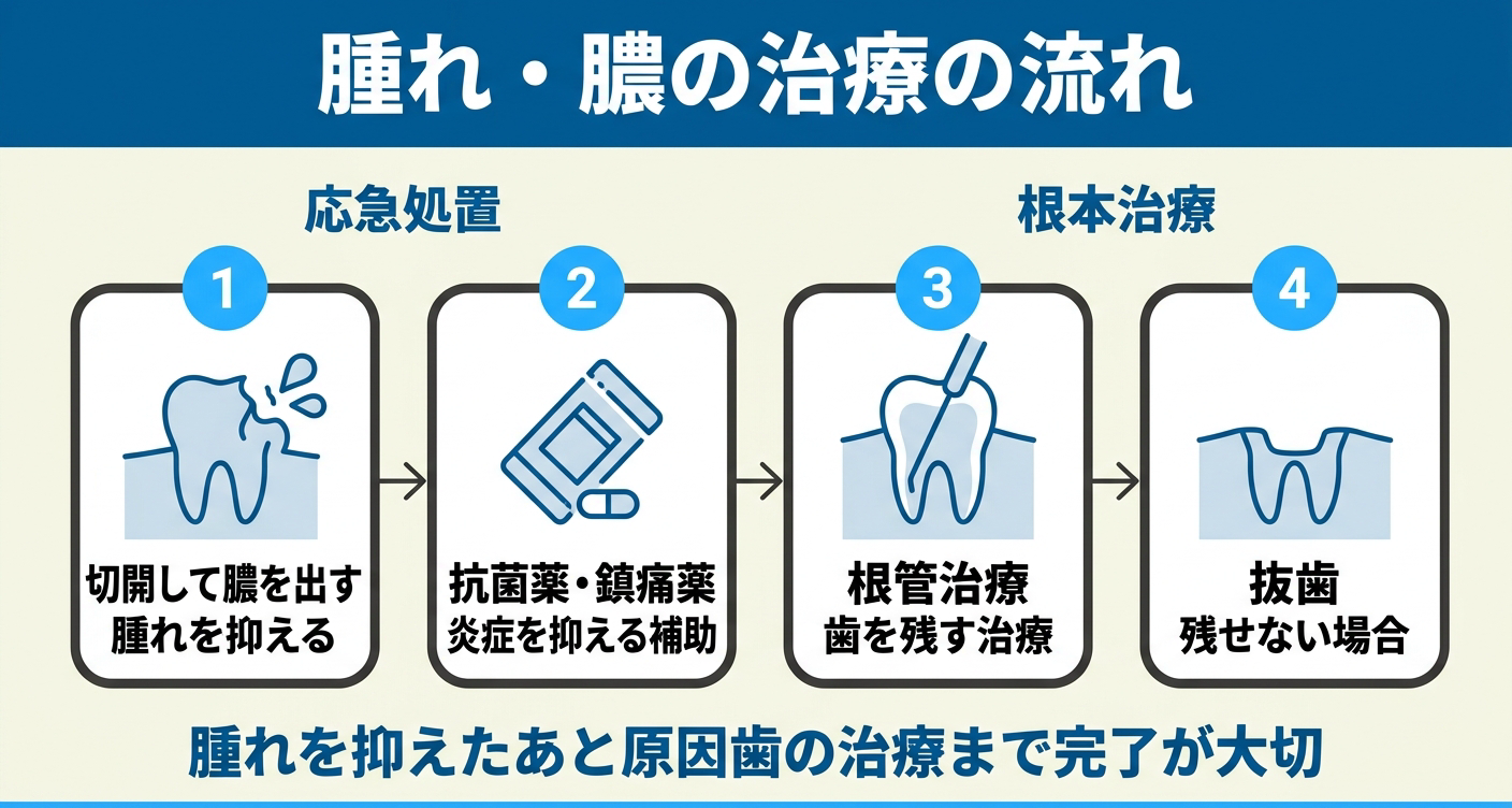 虫歯で腫れ・膿が出たときの歯科での治療の流れを4ステップで整理した図解。切開排膿と抗菌薬で腫れを抑える応急処置のあと、根管治療や抜歯で原因歯を治す根本治療まで進むことを示し、腫れを抑えただけで終えないことの大切さを伝える。