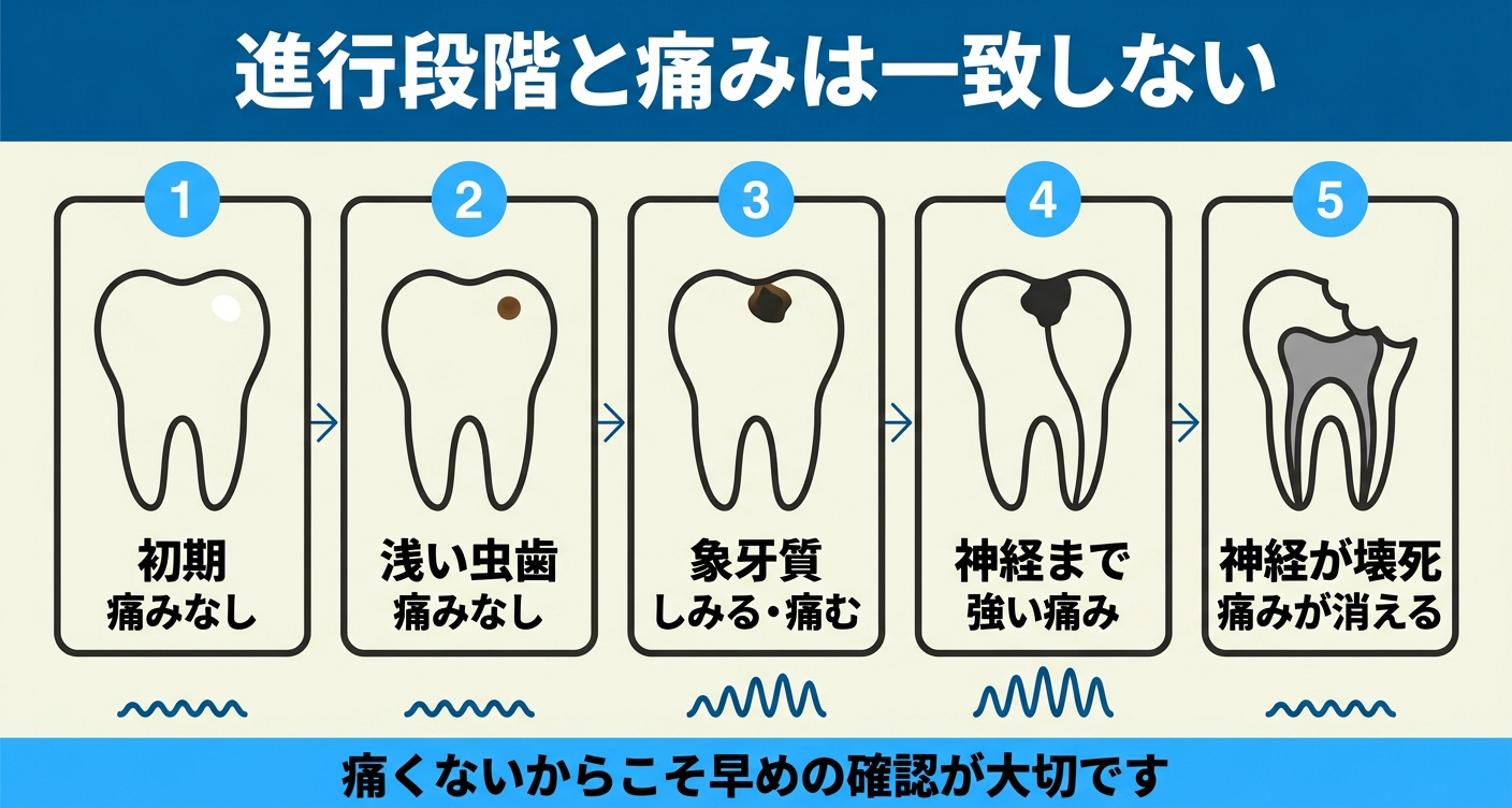 痛くない虫歯の進行段階CO〜C4と痛みの強さが一致しないことを左から右へ5段階で示した図解。初期は痛みがなく、象牙質から神経に進むほど痛みが強まり、神経が壊死すると再び痛みが消える山なりの変化を表し、痛くないからこそ早めの確認が大切なことを伝える。