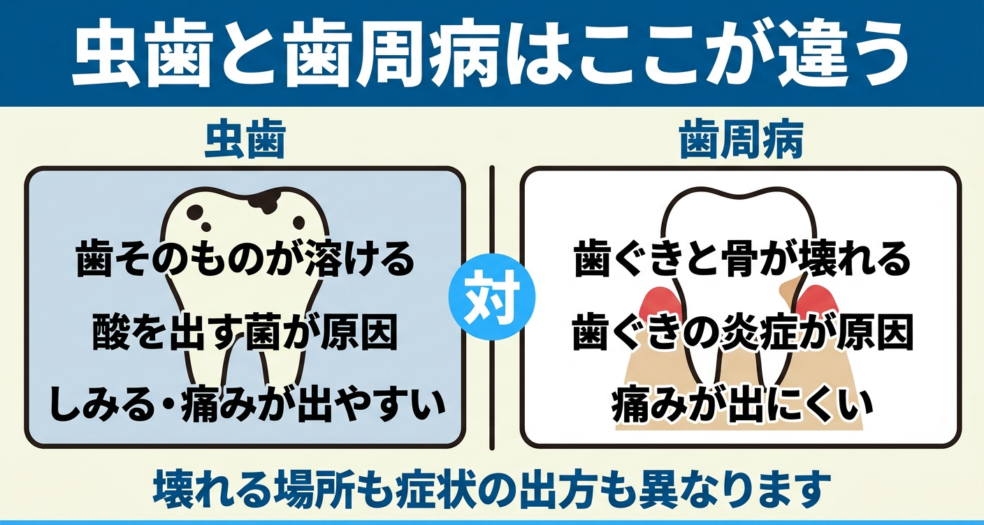 虫歯と歯周病の違いを左右2カラムで対比した図解。虫歯は歯そのものが溶け酸を出す菌が原因でしみや痛みが出ることがあり、歯周病は歯ぐきの炎症から始まり歯を支える骨に影響することがあると並べ、壊れる場所と症状の出方が異なることを示す。