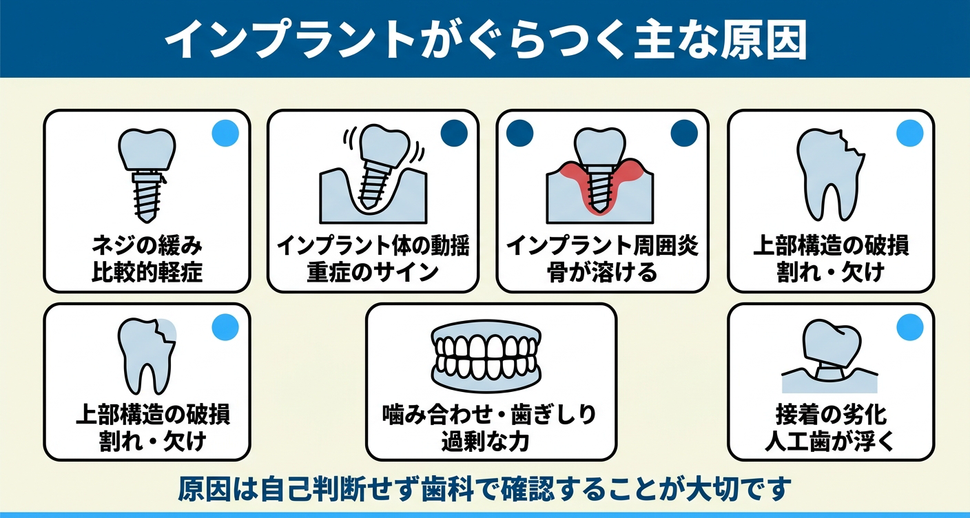 インプラントがぐらつく主な原因を整理した図解。