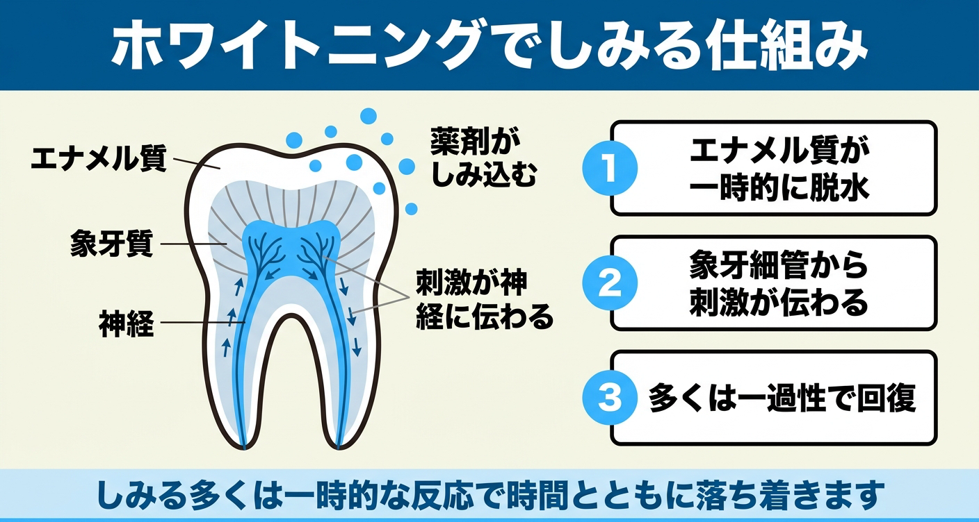 ホワイトニングで知覚過敏が起こる仕組みを歯の断面図で示した図解。薬剤がしみ込み、エナメル質の一時的な脱水や象牙細管を通じて刺激が神経に伝わる流れを描き、しみる多くは一過性の反応で時間とともに落ち着くことを伝える。