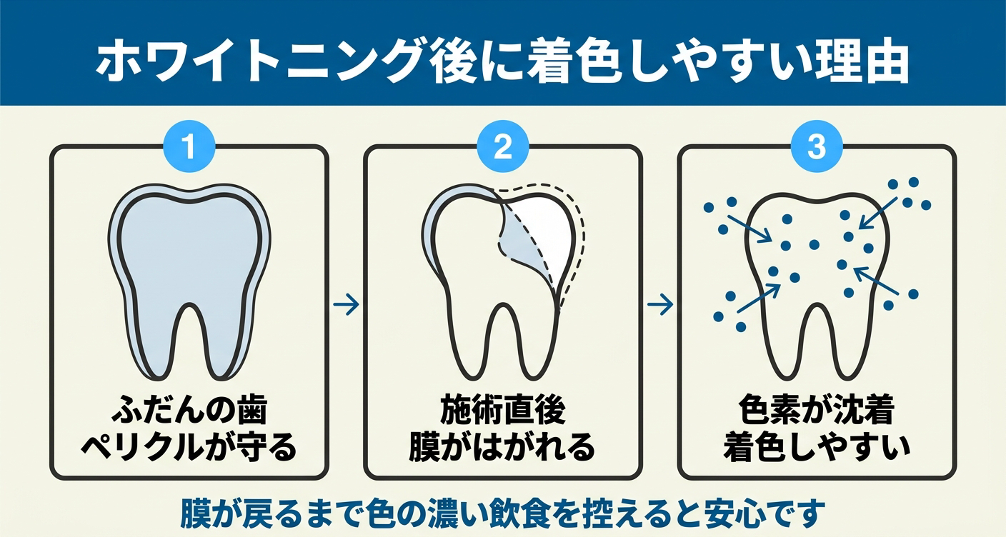 ホワイトニング後に着色しやすくなる理由を3段階で示した図解。ふだんはペリクルの膜が歯を守るが、施術直後はその膜が一時的にはがれて表面がむき出しになり、色素が沈着しやすくなる流れを示し、膜が戻るまで色の濃い飲食を控える大切さを伝える。