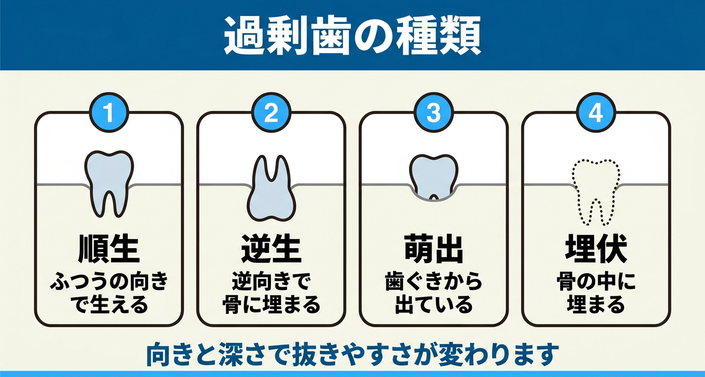 子供の過剰歯の種類を4つのパネルで比較した図解。ふつうの向きで生える順生、鼻側へ逆向きで骨に埋まる逆生、歯ぐきから出ている萌出、骨の中に完全に埋まる埋伏を並べ、向きと深さで抜きやすさが変わることを示した歯科情報イラスト。