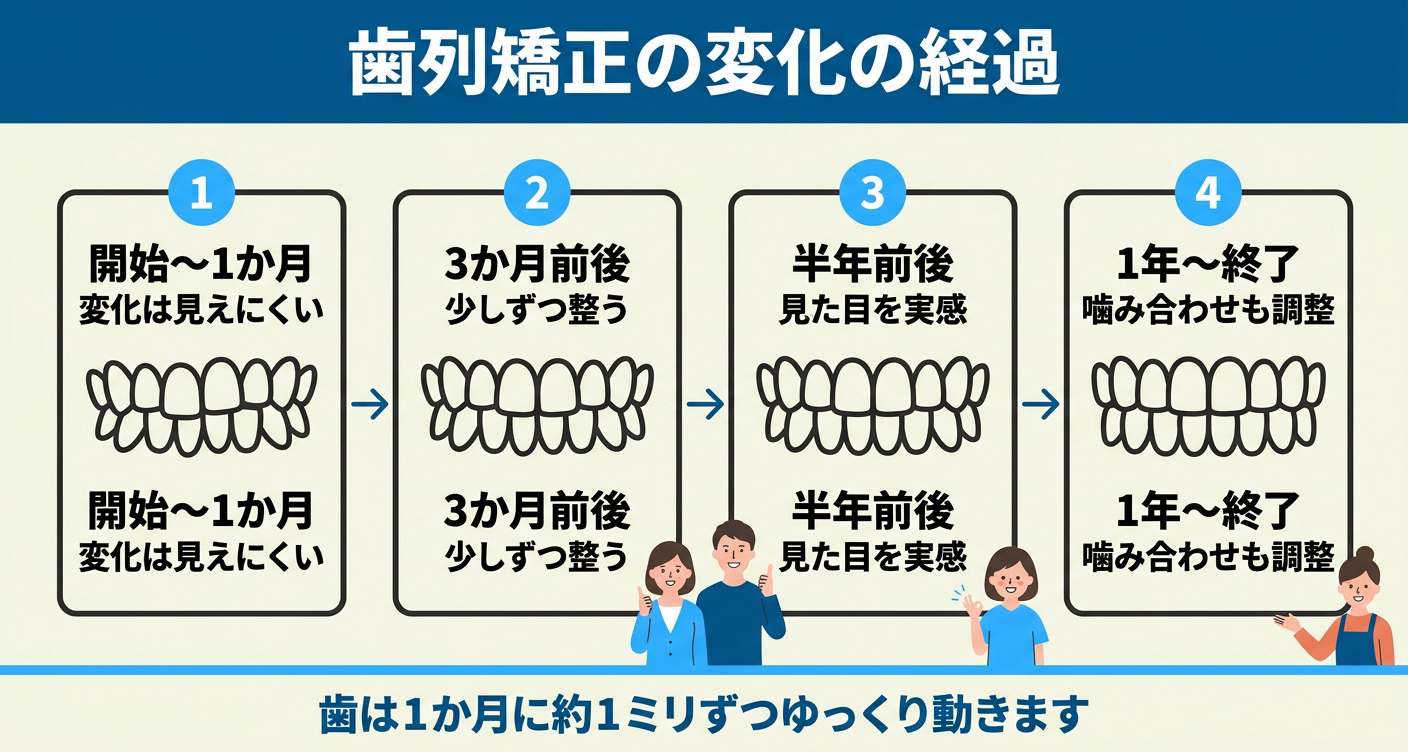 歯列矯正の変化の経過を左から右へ4段階で示した図解。開始から1か月は変化が見えにくく、3か月前後で少しずつ整い、半年ごろに見た目の変化に気づくことがあり、1年から終了にかけて噛み合わせまで調整する流れを、歯が1か月に約1ミリずつ動くという目安とともに整理している。