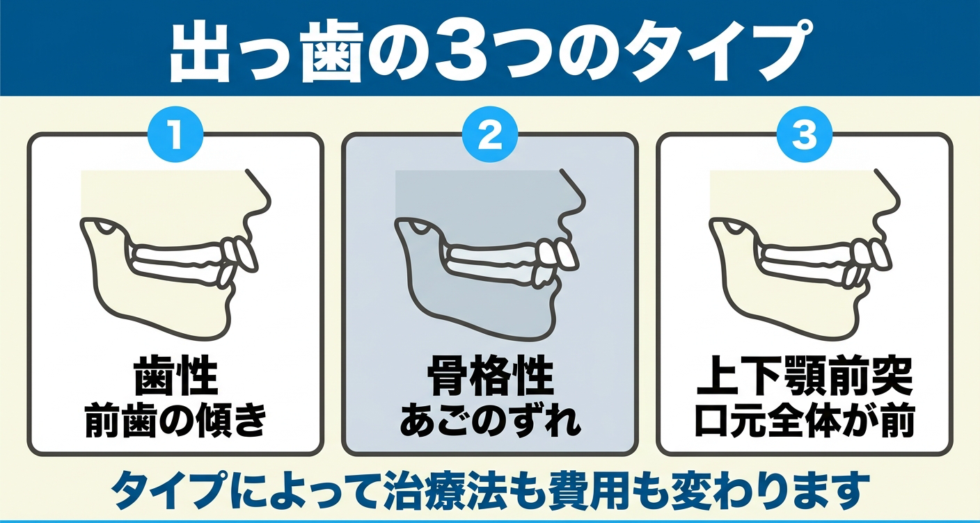 出っ歯(上顎前突)の主なタイプを示した図解