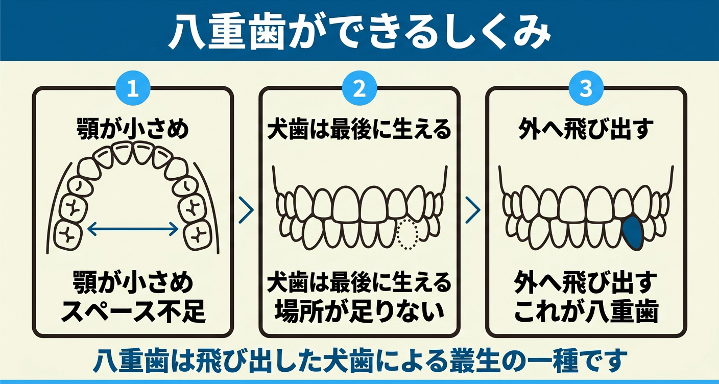 八重歯ができるしくみを3段階で示した図解。顎が小さくスペースが不足する状態から、最後に生える犬歯の場所が足りなくなり、前から3番目の犬歯が外側へ飛び出すまでを並べ、八重歯が飛び出した犬歯による叢生の一種であることを伝える歯科イラスト。