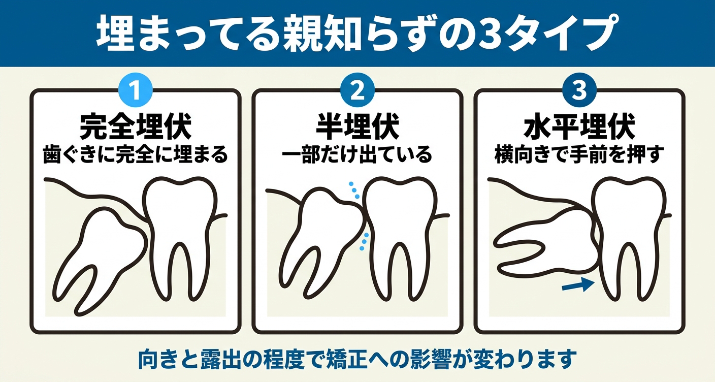 埋まっている親知らずを完全埋伏・半埋伏・水平埋伏に分けて整理した図解