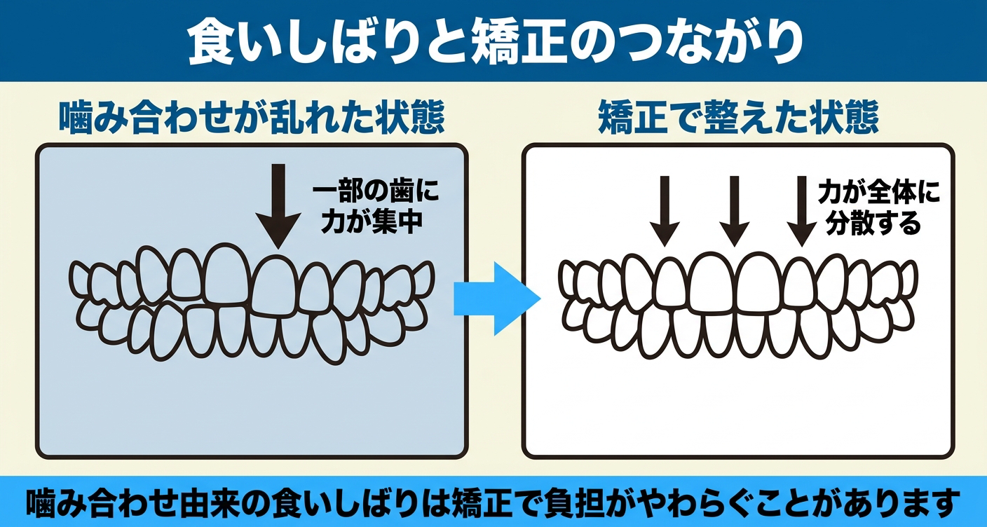 食いしばりと歯列矯正のつながりを左右対比で示した図解。噛み合わせが乱れて一部の歯に力が集中する状態から、矯正で整えて力が全体に分散する状態へ向かう様子を矢印で表し、噛み合わせ由来の食いしばりは矯正で負担がやわらぐことがある点を伝える。