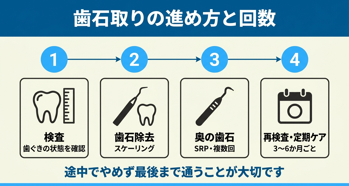 歯石取りの進め方と回数を4ステップで示した図解。検査で歯ぐきの状態を確認し、スケーリングで歯石除去、SRPで奥の歯石を複数回かけて取り、再検査と3〜6か月ごとの定期ケアへと進む流れを並べ、途中でやめず最後まで通う大切さを伝える。