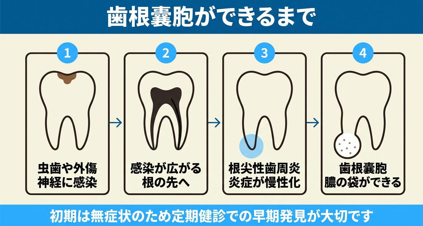 歯根嚢胞ができるまでの流れを左から右へ4段階で示した図解。虫歯や外傷による神経への感染から、感染が根の先へ広がり、根尖性歯周炎が慢性化し、根の先に膿の袋(歯根嚢胞)ができる過程を並べ、初期は無症状のため定期健診での早期発見が大切なことを伝える。
