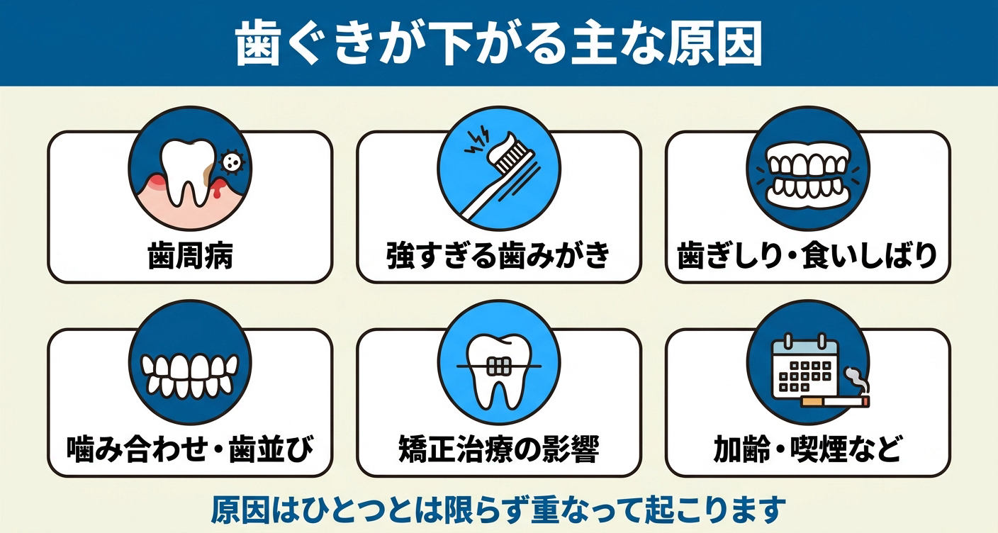 歯茎が後退する主な原因を6つのカードで示した図解。歯周病、強すぎる歯みがき、歯ぎしり・食いしばり、噛み合わせ・歯並び、矯正治療の影響、加齢・喫煙などを並べ、原因はひとつとは限らず重なって起こることを伝える歯科情報イラスト。