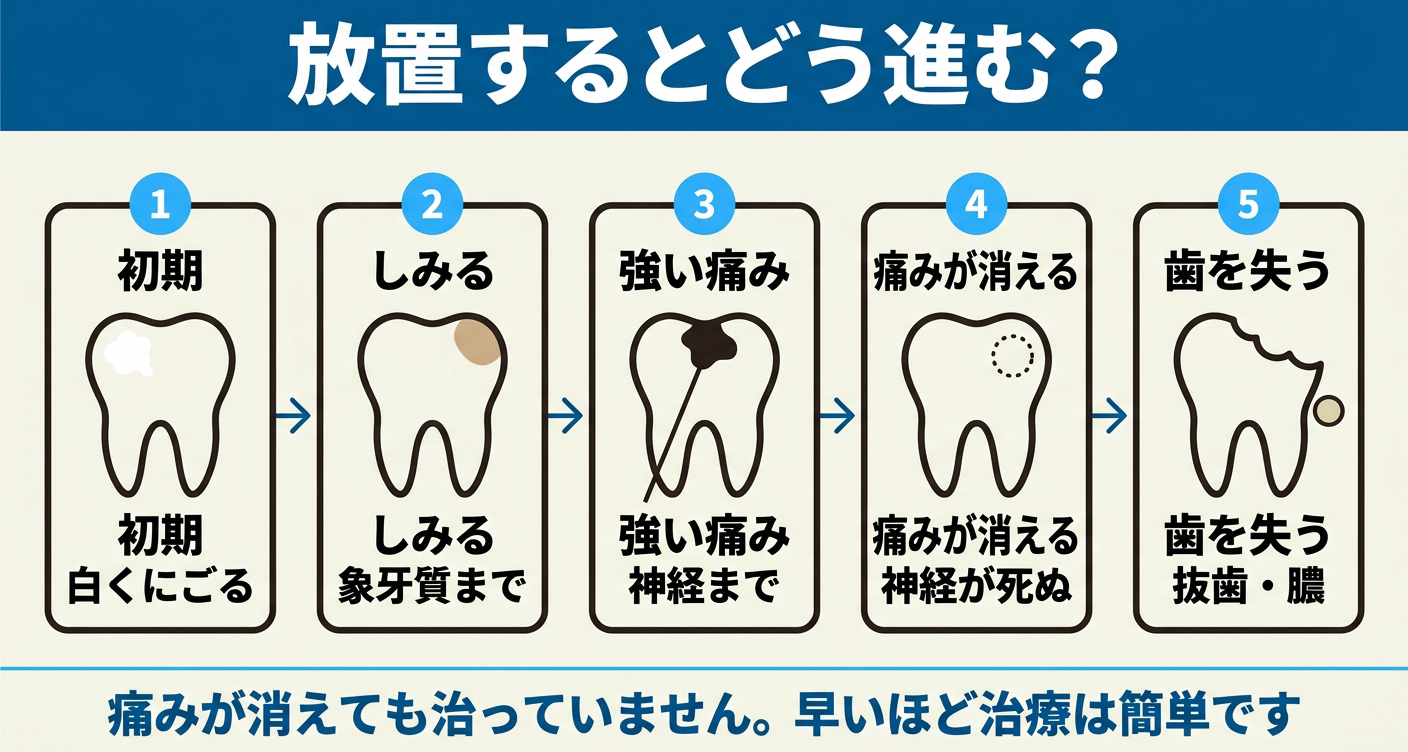 歯医者に行かないと虫歯がどう進むかを左から右へ5段階で示した図解。白くにごる初期から、しみる象牙質、神経までの強い痛み、痛みが消えて神経が壊死する可能性がある段階、歯を失い抜歯や膿に至る場合まで並べ、痛みが消えても治ったとは限らず早期受診ほど負担を抑えられる可能性があることを伝える。