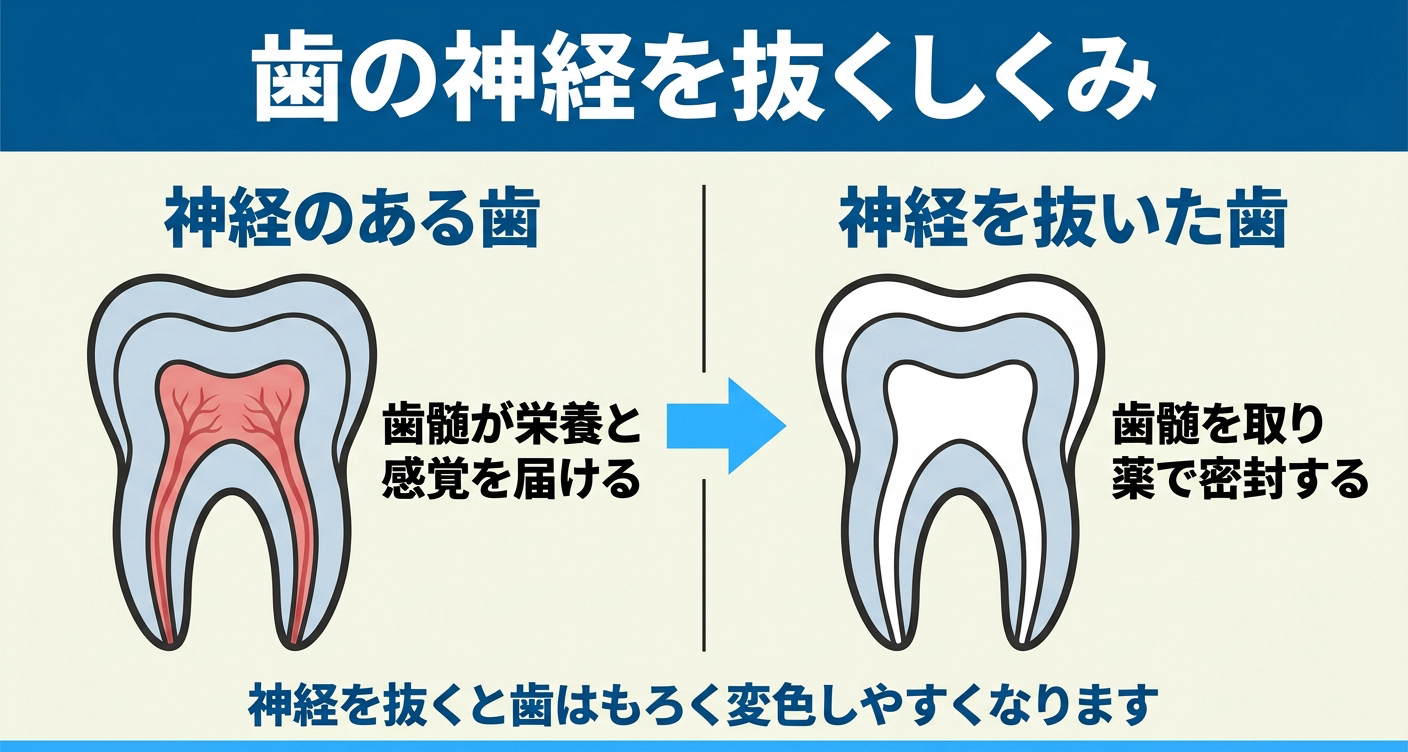 虫歯で神経を抜くしくみを、神経のある歯と神経を抜いた歯で対比した図解。歯髄が栄養と感覚を届ける状態と、歯髄を取り薬で密封した状態を歯の断面で示し、神経を抜くと歯がもろく変色しやすくなることを伝える根管治療の解説イラスト。