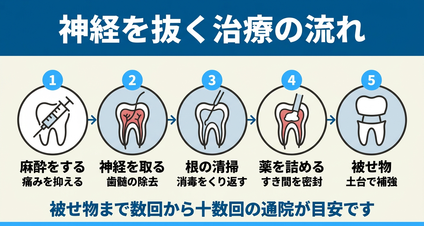虫歯で神経を抜く治療の流れを左から右へ5ステップで示した図解。麻酔、神経(歯髄)の除去、根の清掃と消毒、薬の充填、被せ物と土台での補強の順に並べ、被せ物まで数回から十数回の通院が目安になることを伝える根管治療の解説イラスト。