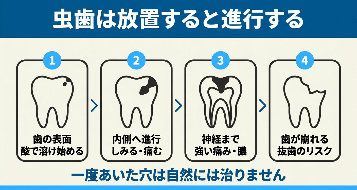 虫歯を放置するとどうなるかを4段階のフローで示した図解。歯の表面が酸で溶け始める段階から、内側への進行、神経までの強い痛みや膿、歯が崩れて抜歯のリスクに至る流れを並べ、一度あいた穴は自然には治りにくいことを伝える。