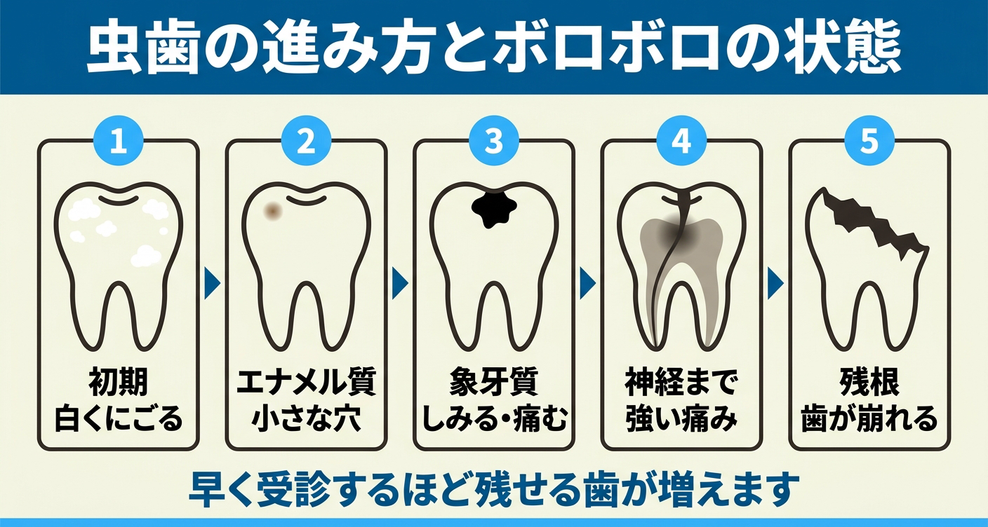 虫歯でボロボロになる進行段階を左から右へ5段階で示した図解。白くにごる初期から、小さな穴、しみる象牙質、神経までの強い痛み、根だけが残る残根まで並べ、早く受診するほど残せる歯が増えることを伝える歯科向けインフォグラフィック。