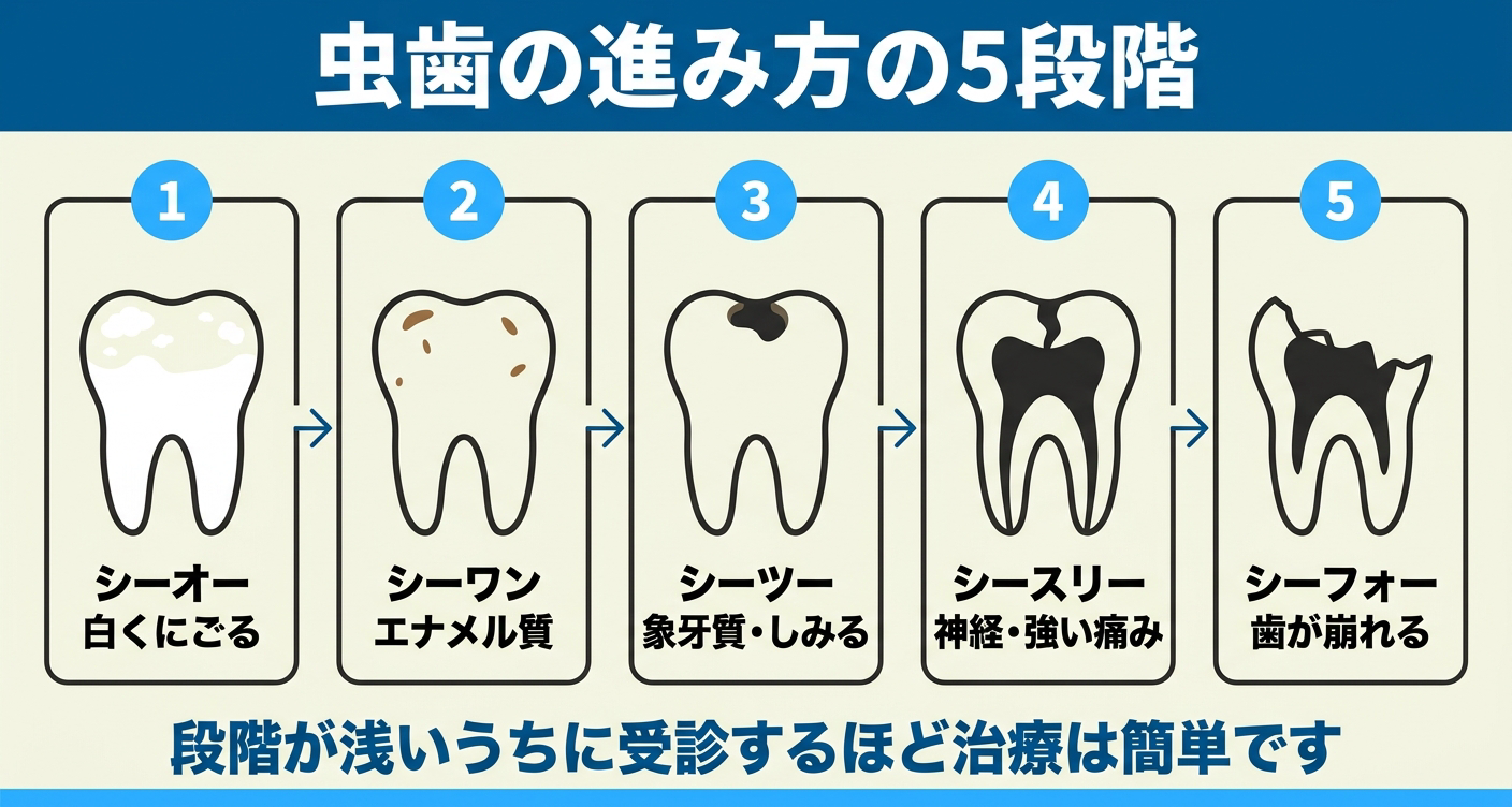 虫歯の段階を左から右へ5段階で示した図解。白くにごる初期から、エナメル質、象牙質でしみる、神経までの強い痛み、歯が崩れる重度まで並べ、段階が浅いうちに受診するほど治療の負担を抑えやすいことを伝える虫歯の進行段階インフォグラフィック。