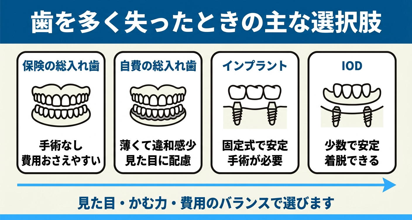 歯を多く失ったときの主な選択肢を4つのパネルで比較した図解。保険の総入れ歯、自費の総入れ歯、インプラント、インプラントオーバーデンチャー（IOD）を並べ、見た目・かむ力・費用のバランスで選ぶことを示す歯科情報イラスト。