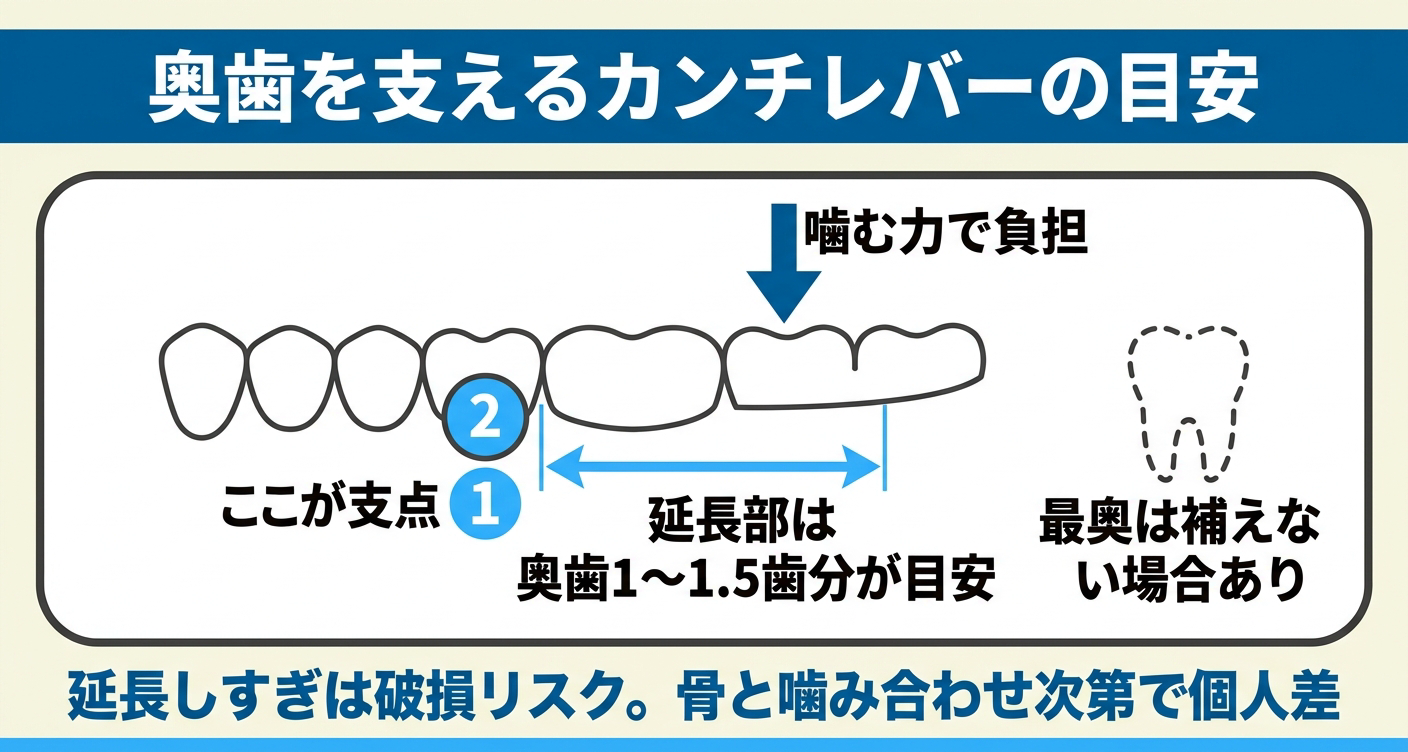 オールオン4の奥歯を支えるカンチレバーの考え方を整理した図解