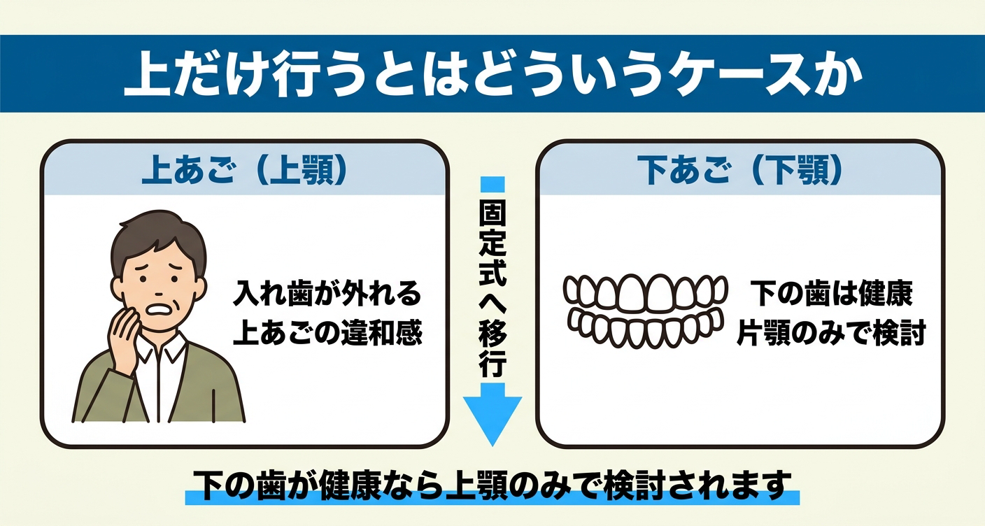 オールオン4を上だけ行うケースを上顎と下顎の状態で整理した図解