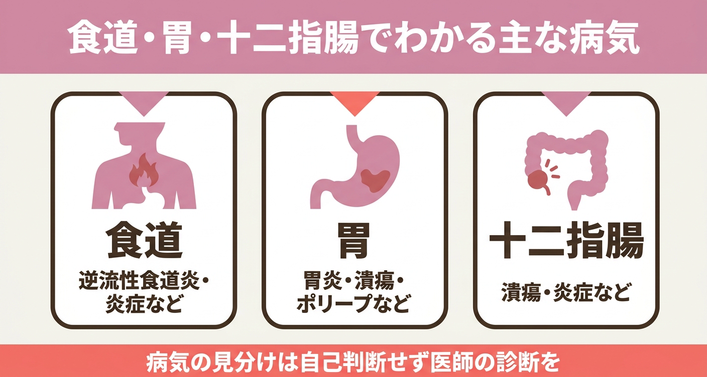 胃カメラで確認される主な所見を食道・胃・十二指腸別に整理した図