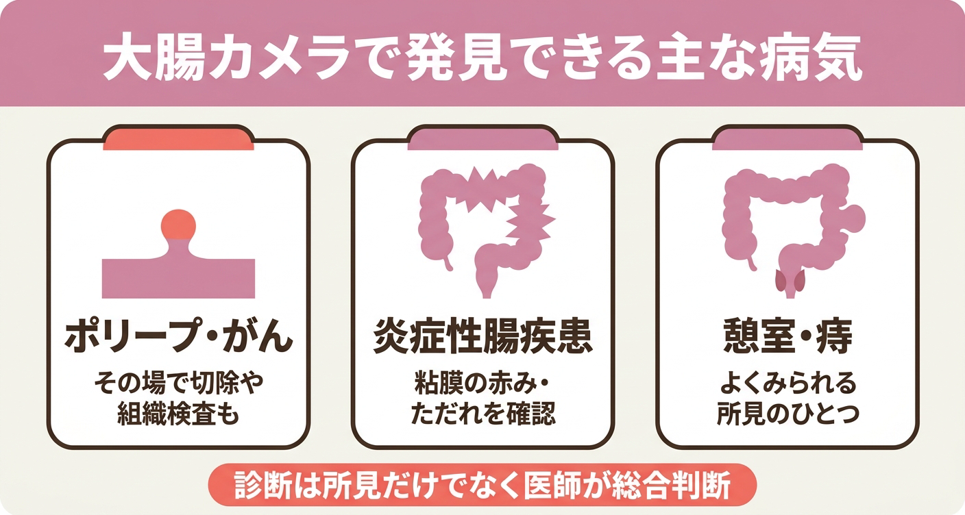 大腸カメラで確認される主な病変をポリープ・がん・炎症性腸疾患・憩室などに分けて示した図