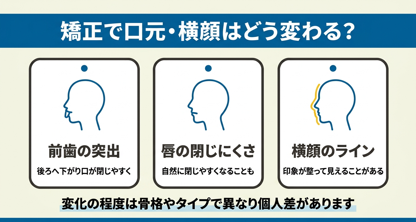 出っ歯の歯列矯正で口元・横顔がどう変わるかを「前歯の突出」「唇の閉じにくさ」「横顔のライン」の3カードで整理した図解。前歯が下がって口が閉じやすくなることや横顔の印象の変化を視覚的に示しつつ、変化の程度には骨格やタイプによる個人差があることを伝えます。