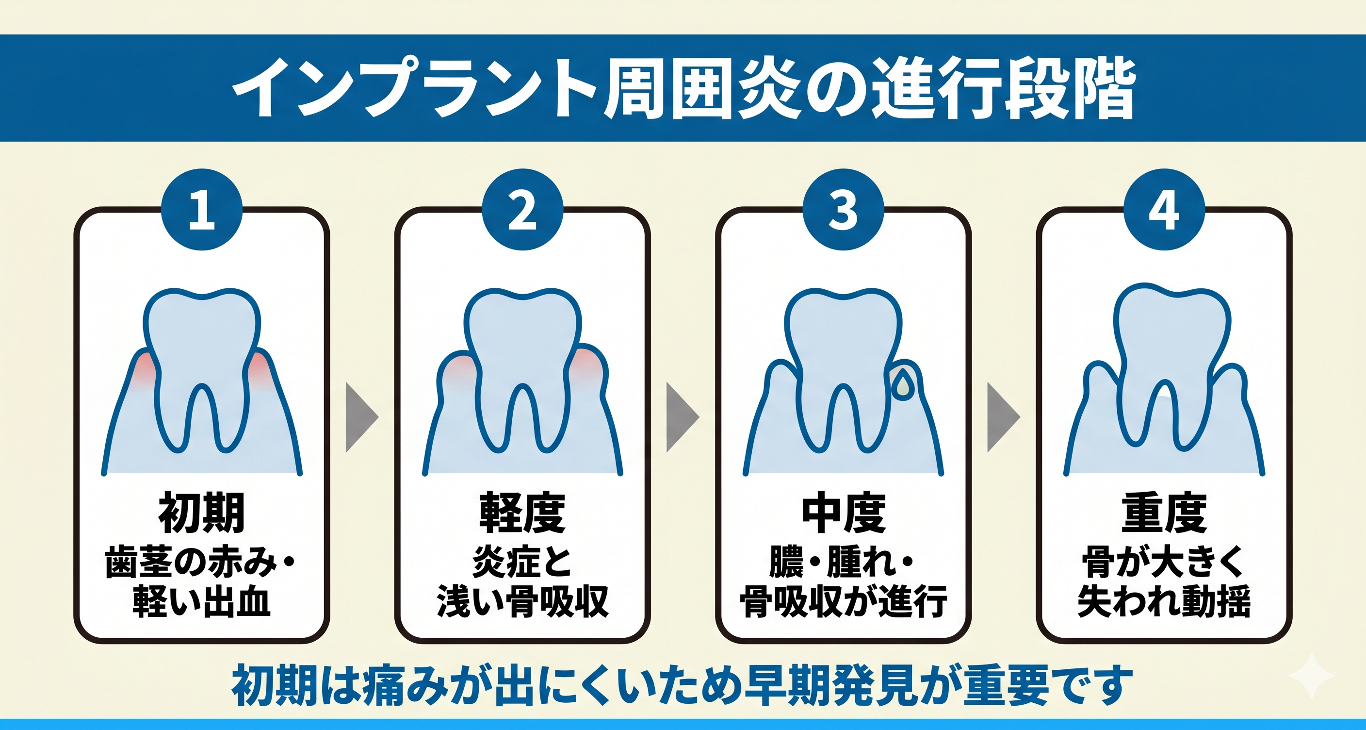 インプラント周囲炎の症状と進行段階を初期から重度まで4段階で示した図解。