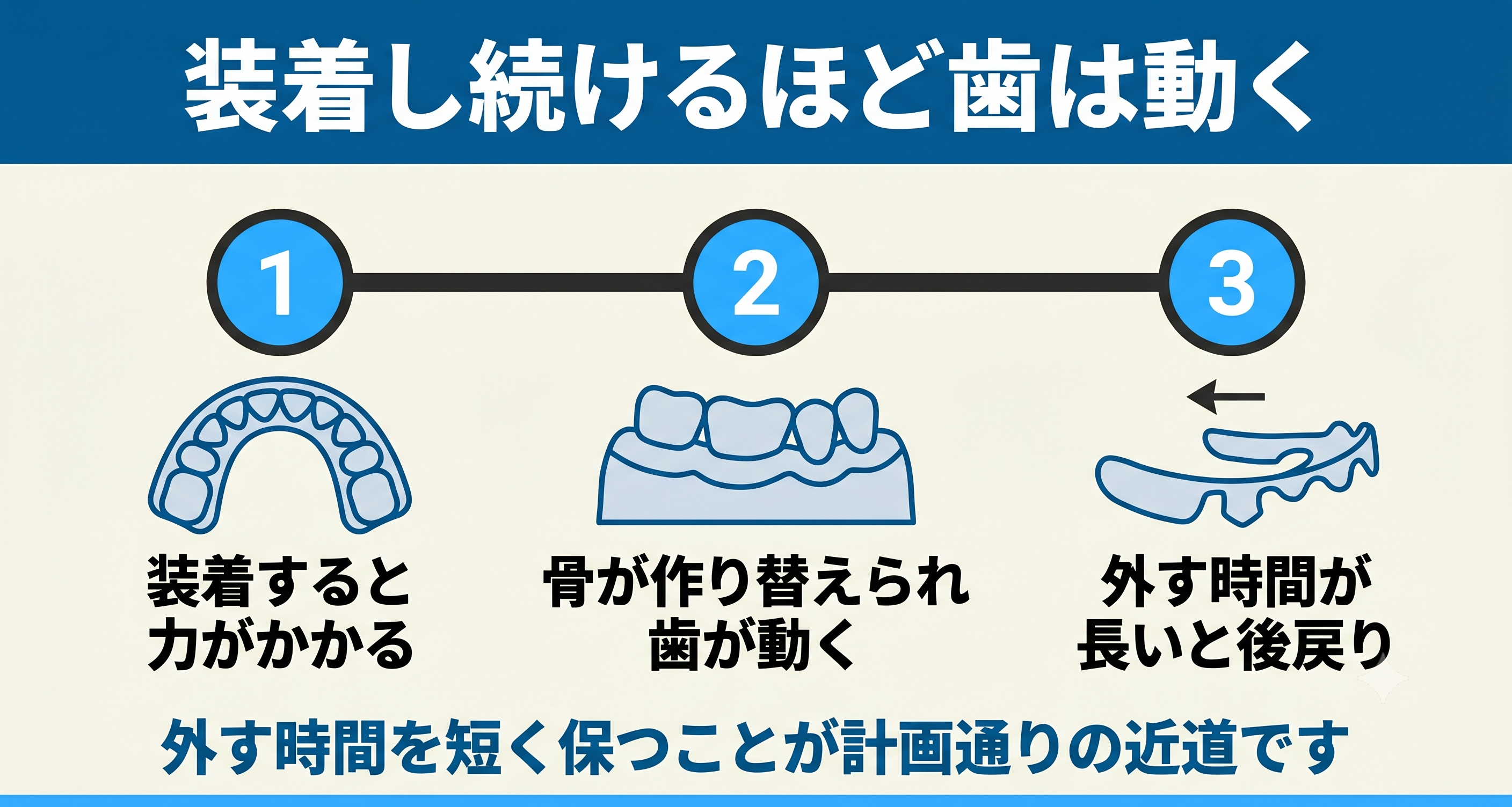 なぜインビザラインの装着時間が1日20〜22時間必要なのかを示す図解。装着すると力がかかり、骨が作り替えられて歯が動くこと、外す時間が長いと後戻りすることを3段階で表し、外す時間を短く保つ大切さを伝える。