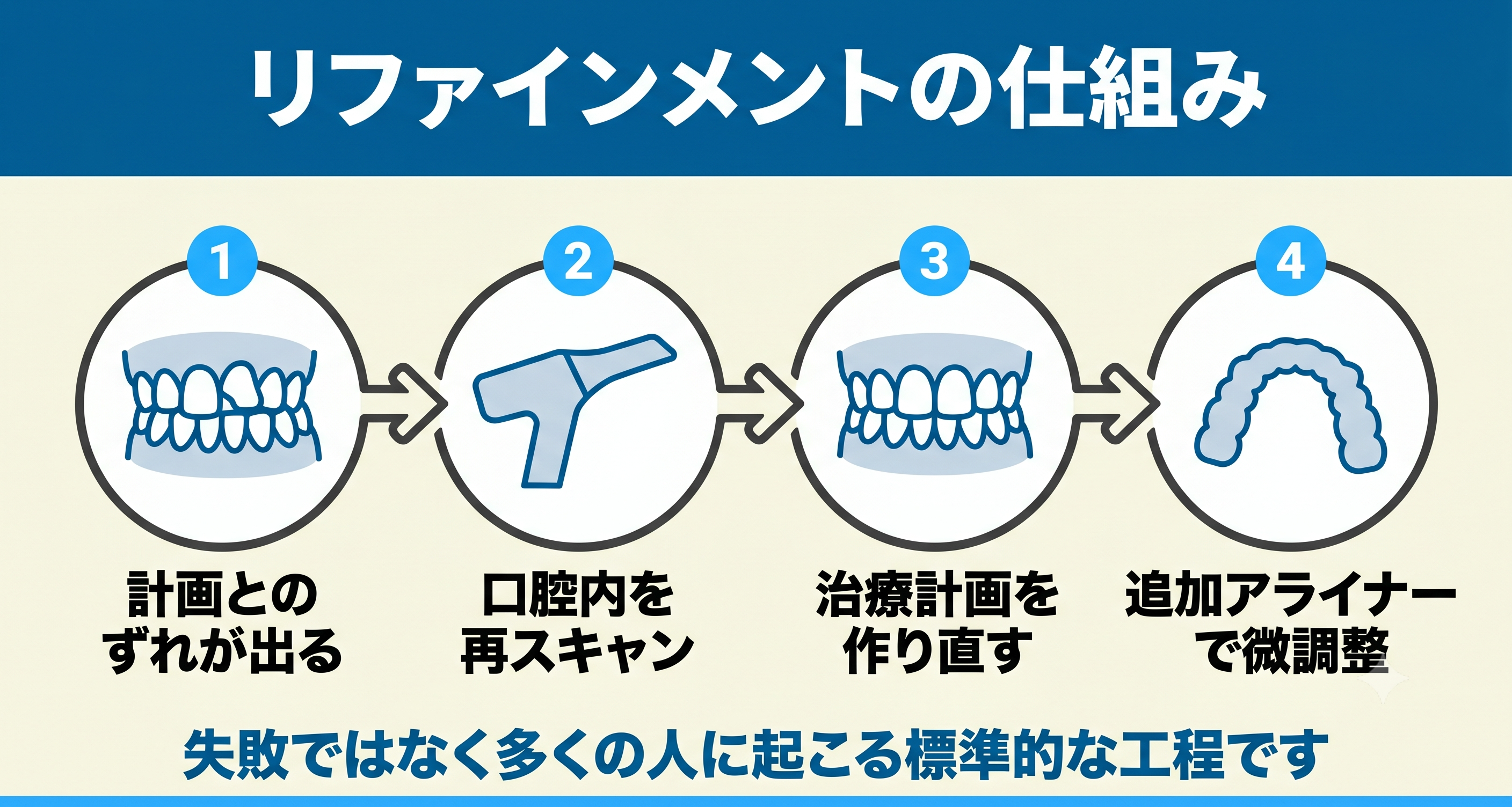 インビザラインのリファインメント（追加アライナー）の仕組みを4ステップで示した図解。計画とのずれを再スキャンで確認し、治療計画を作り直して追加アライナーで微調整する流れを示す。