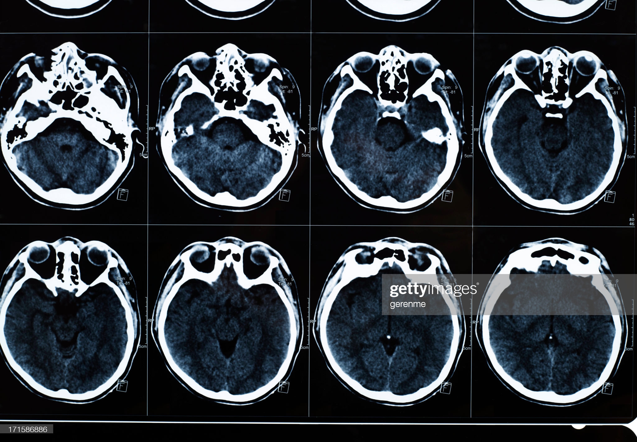 Brain Mri Image Classification Using Deep Learning