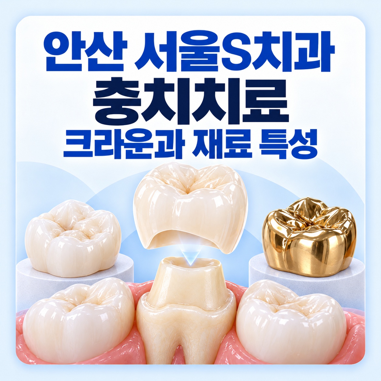 안산 서울S치과 충치치료 크라운 보호 범위와 재료 특성 안내