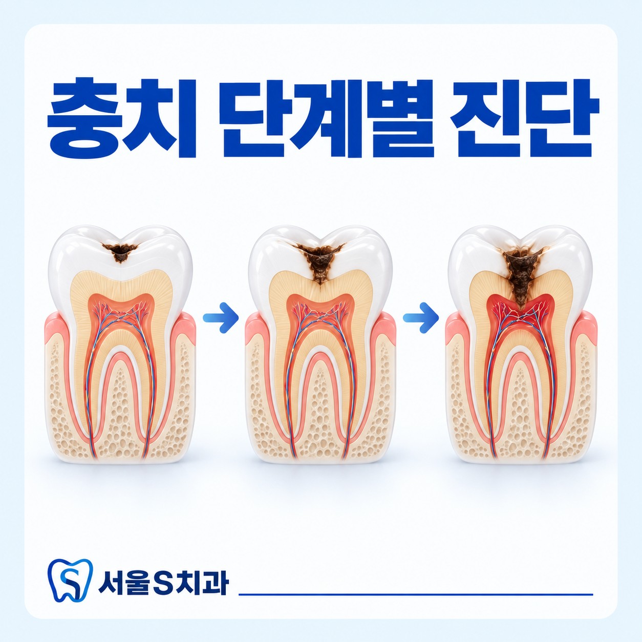 안산 고잔동 서울S치과 충치 진행 단계 상담
