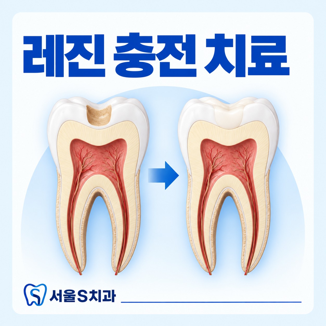 안산 고잔동 서울S치과 레진 충전 치료