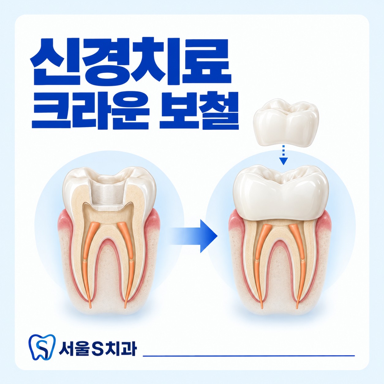 안산 고잔동 서울S치과 신경치료 및 크라운 보철