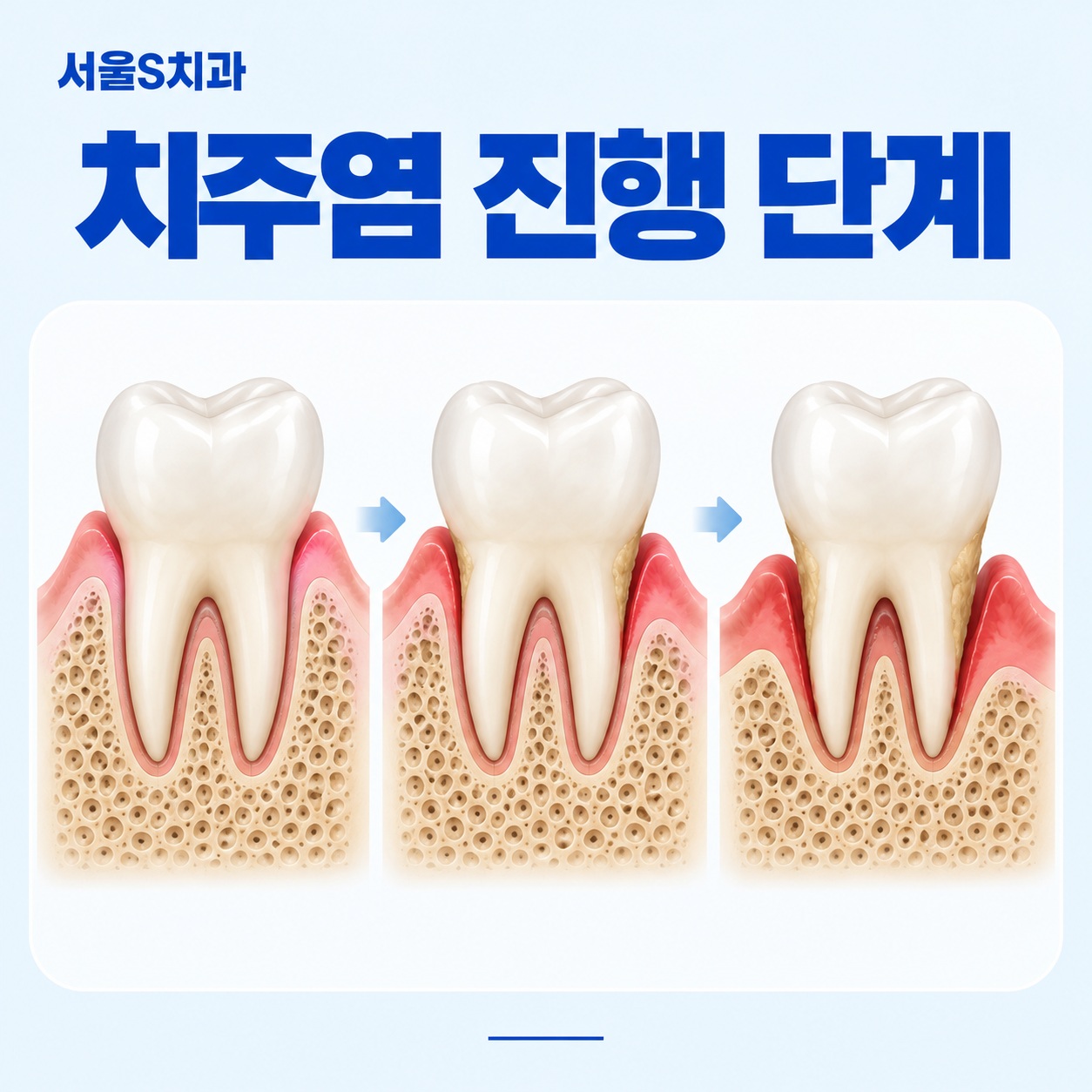 안산 고잔동 치과 치은염 치주염 진행 단계 이미지