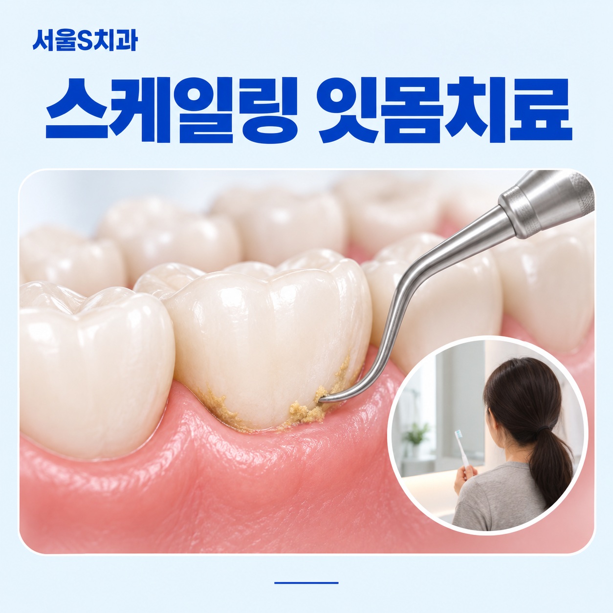 안산 고잔동 서울S치과 스케일링 잇몸치료 이미지