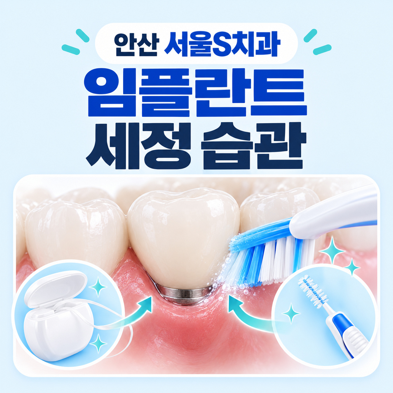 안산 서울S치과 임플란트 세정 습관 안산 고잔동 서울S치과 임플란트 양치와 잇몸 점검 체크리스트