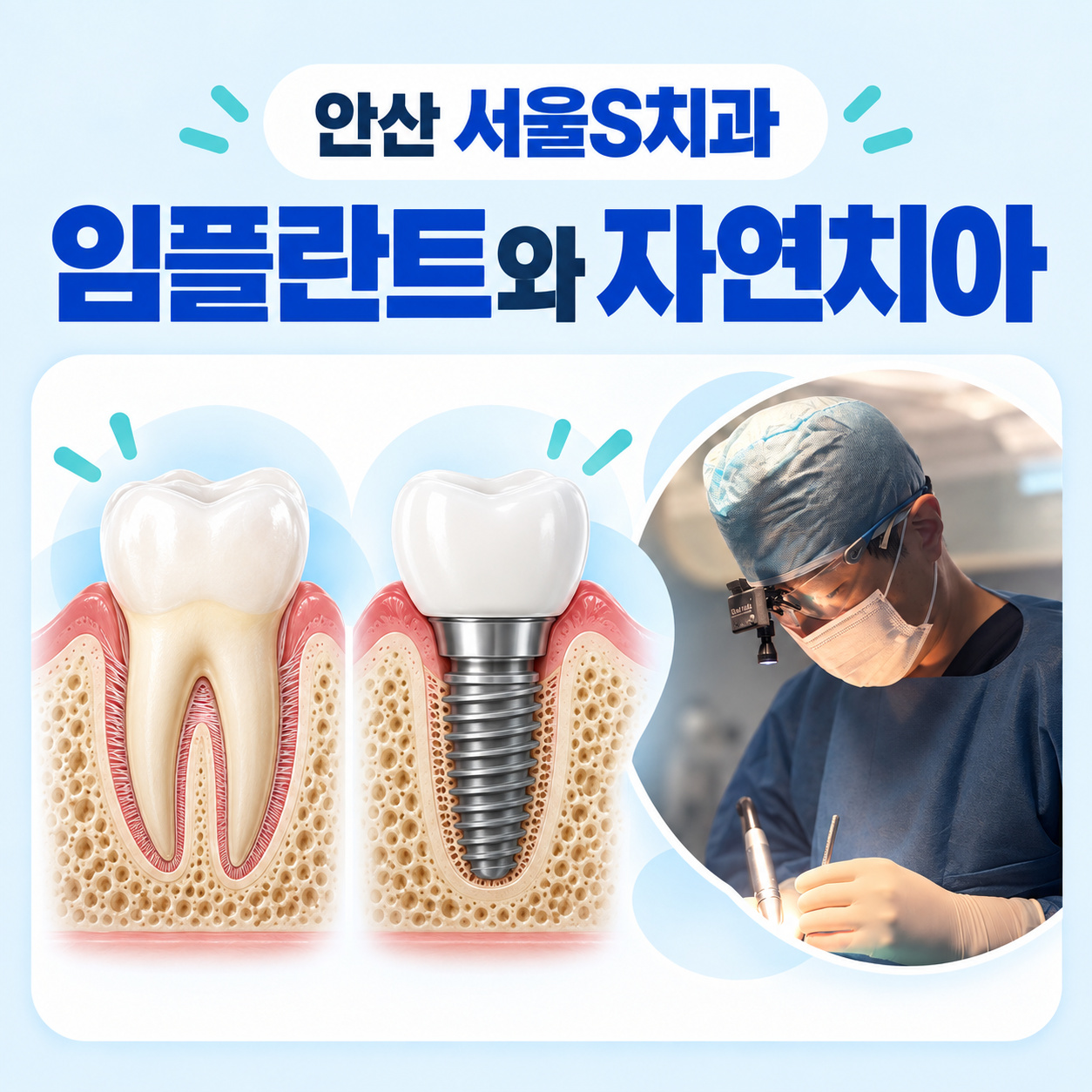 안산 서울S치과 임플란트와 자연치아 안산 고잔동 서울S치과 임플란트 골유착과 자연치아 구조 차이