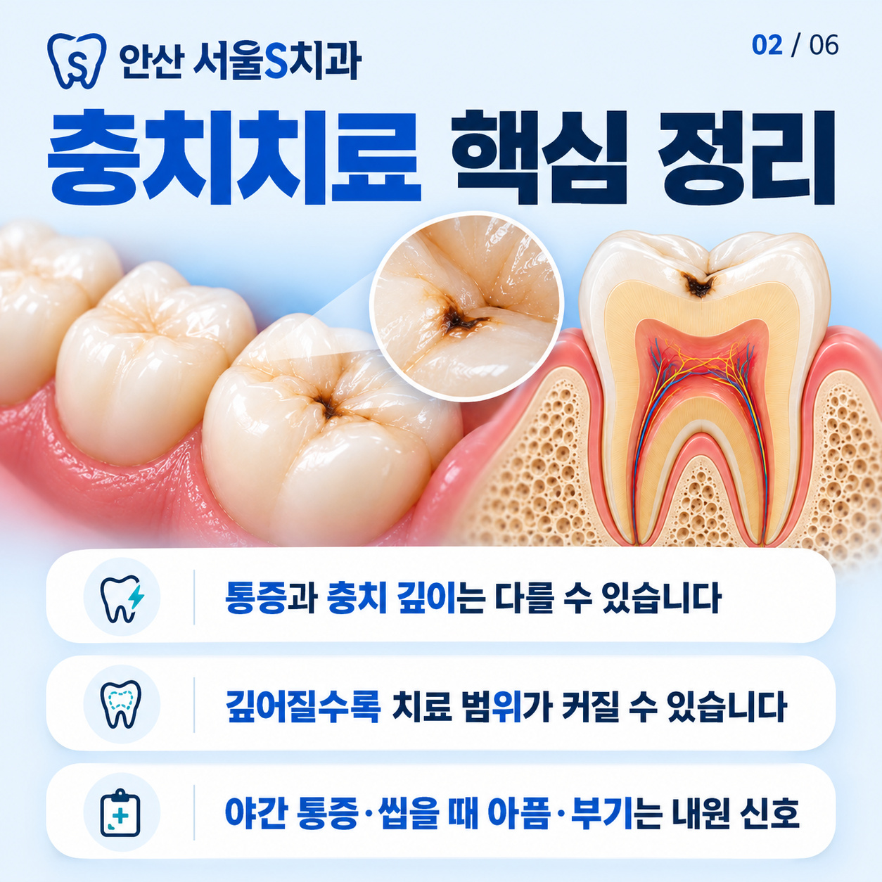 안산 고잔동 서울S치과 충치치료 단계와 방문 계획 핵심 요약