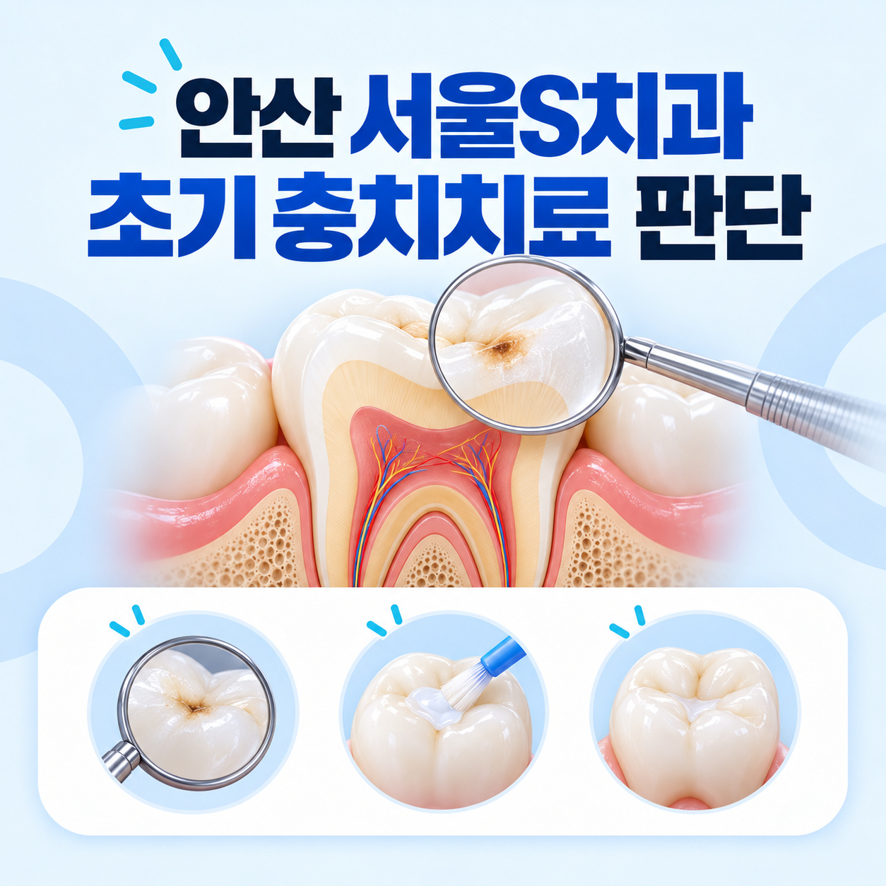 안산 고잔동 서울S치과 충치치료 초기 법랑질 병변과 검진 안내